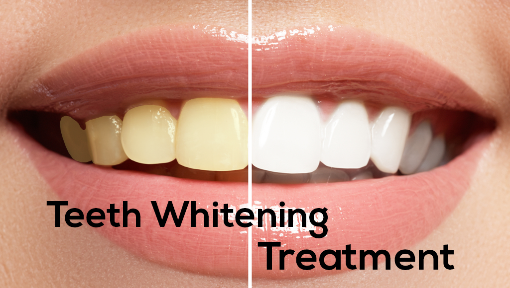 Teeth Whitening Treatment